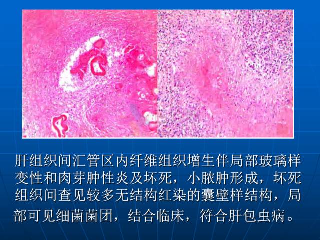 【PPT】肝包虫CT诊断