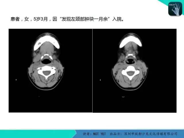 【病例】鳃裂囊肿伴感染1例CT影像表现