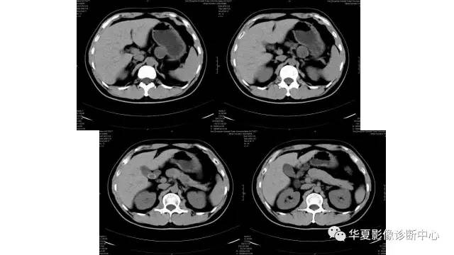 【病例】胰腺神经内分泌肿瘤1例CT影像表现