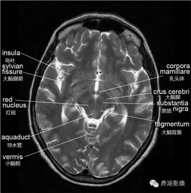 高清头颅MRI断层图谱