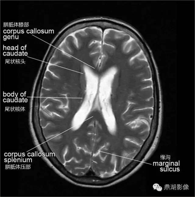 高清头颅MRI断层图谱