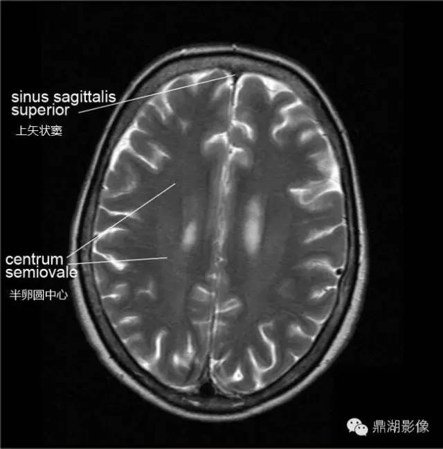 高清头颅MRI断层图谱