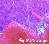 【病例】脾脏破裂1例CT影像诊断分析 【病例】脾脏破裂1例CT影像诊断分析