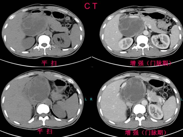 【病例】肝滤泡树突细胞肉瘤1例CT影像表现