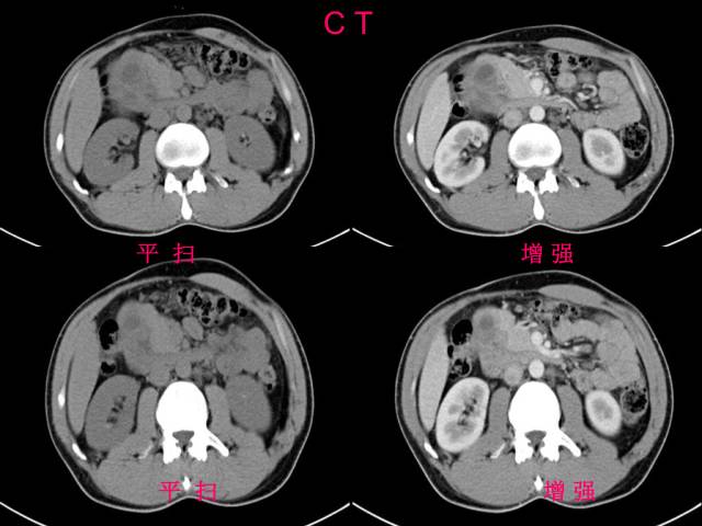 【病例】肝滤泡树突细胞肉瘤1例CT影像表现