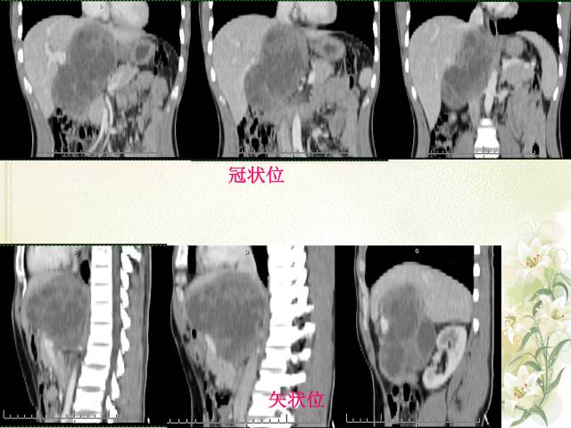 【病例】肝滤泡树突细胞肉瘤1例CT影像表现