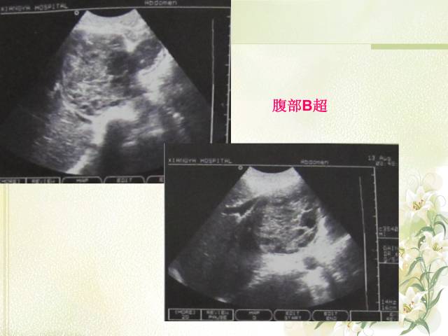 【病例】肝滤泡树突细胞肉瘤1例CT影像表现