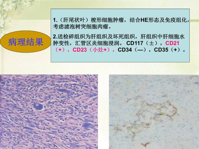 【病例】肝滤泡树突细胞肉瘤1例CT影像表现