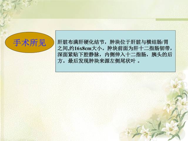 【病例】肝滤泡树突细胞肉瘤1例CT影像表现