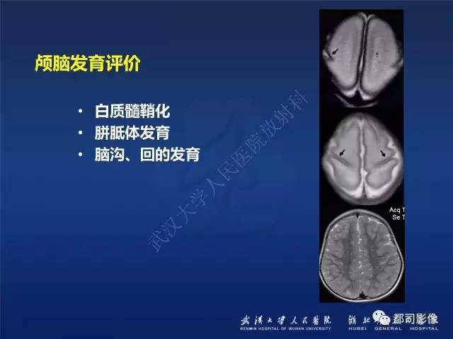 【PPT】新生儿缺氧缺血性脑病影像诊断