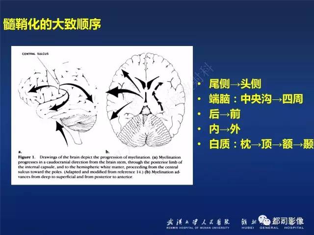 【PPT】新生儿缺氧缺血性脑病影像诊断