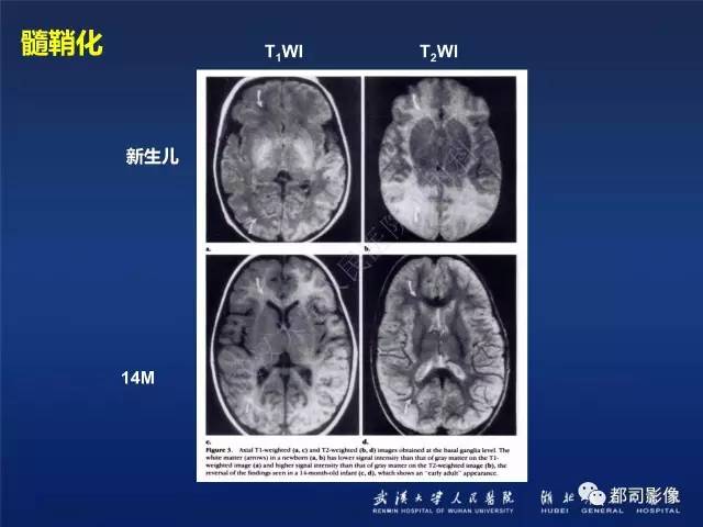 【PPT】新生儿缺氧缺血性脑病影像诊断