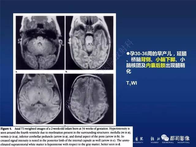 【PPT】新生儿缺氧缺血性脑病影像诊断
