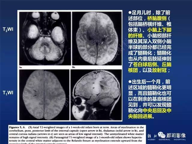 【PPT】新生儿缺氧缺血性脑病影像诊断