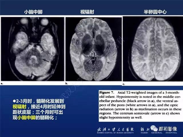 【PPT】新生儿缺氧缺血性脑病影像诊断