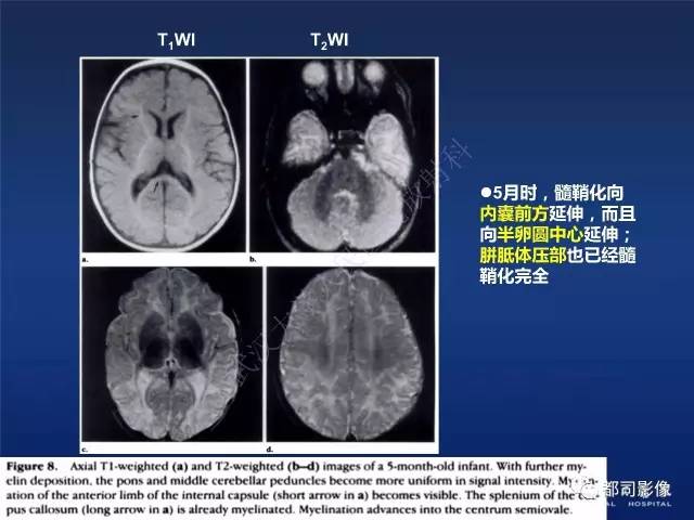 【PPT】新生儿缺氧缺血性脑病影像诊断
