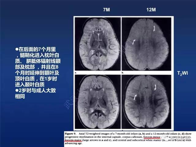 【PPT】新生儿缺氧缺血性脑病影像诊断