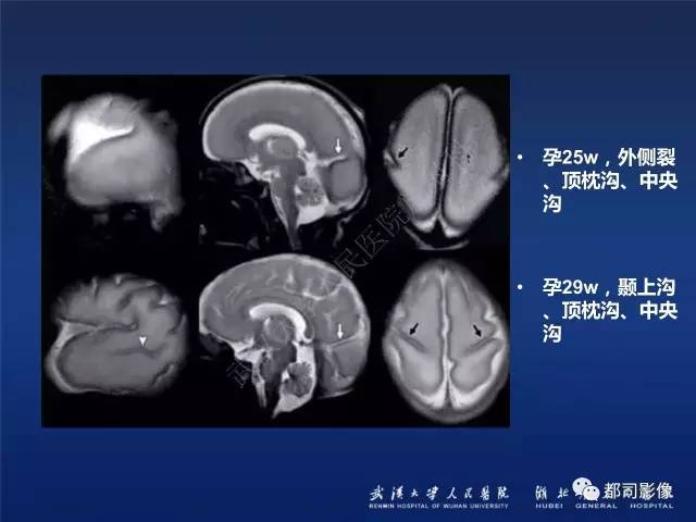 【PPT】新生儿缺氧缺血性脑病影像诊断