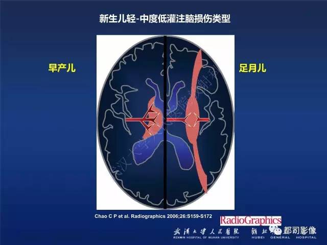 【PPT】新生儿缺氧缺血性脑病影像诊断