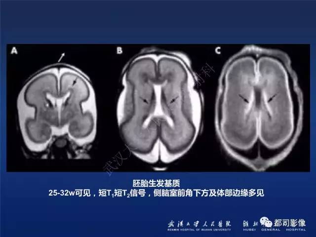 【PPT】新生儿缺氧缺血性脑病影像诊断