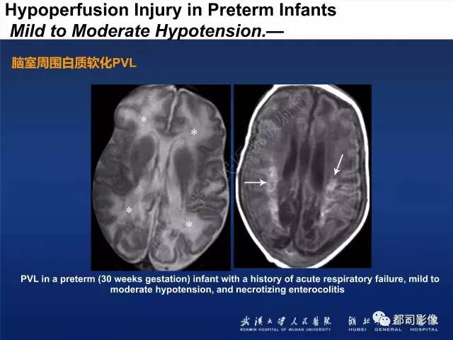 【PPT】新生儿缺氧缺血性脑病影像诊断