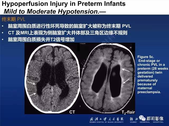【PPT】新生儿缺氧缺血性脑病影像诊断