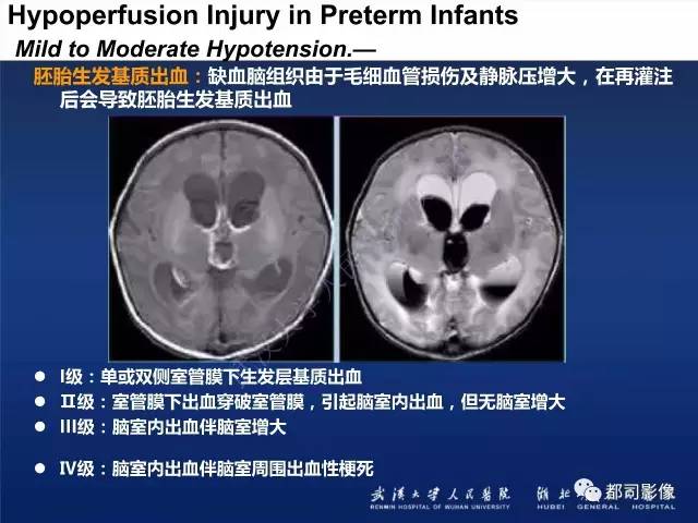 【PPT】新生儿缺氧缺血性脑病影像诊断
