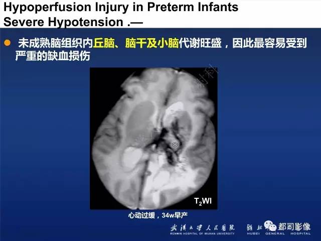 【PPT】新生儿缺氧缺血性脑病影像诊断