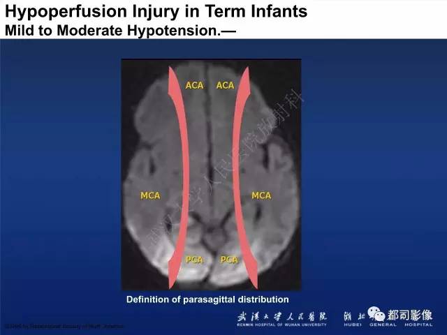 【PPT】新生儿缺氧缺血性脑病影像诊断