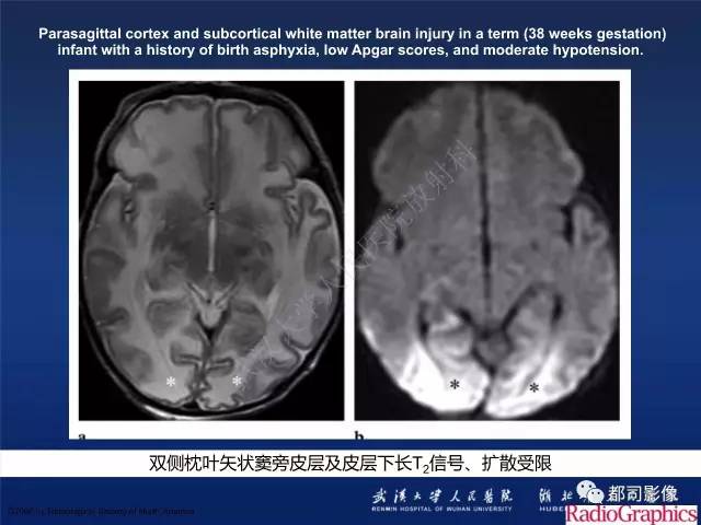 【PPT】新生儿缺氧缺血性脑病影像诊断