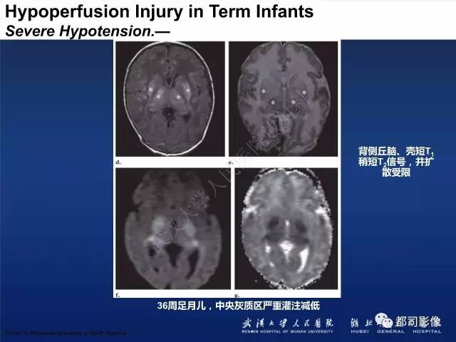 【PPT】新生儿缺氧缺血性脑病影像诊断