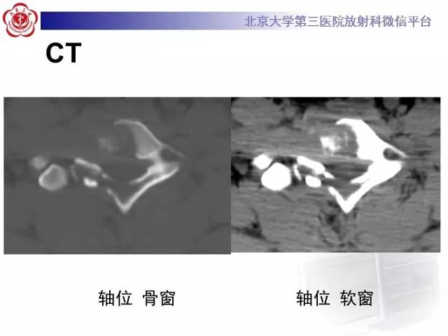 【病例】颈椎朗格汉斯组织细胞增生症1例CT及MR影像诊断