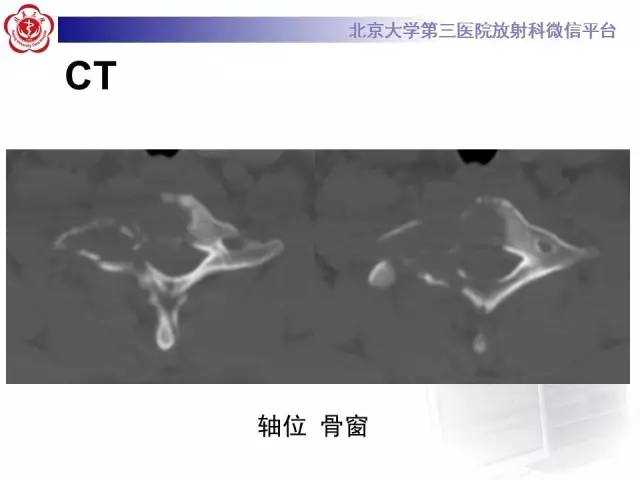 【病例】颈椎朗格汉斯组织细胞增生症1例CT及MR影像诊断