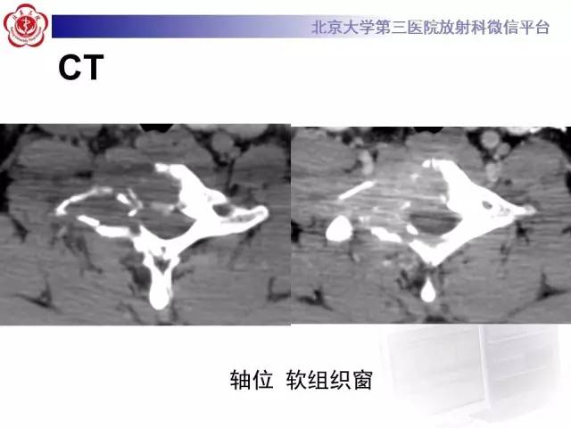 【病例】颈椎朗格汉斯组织细胞增生症1例CT及MR影像诊断