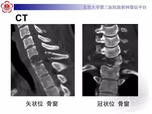 【病例】颈椎朗格汉斯组织细胞增生症1例CT及MR影像诊断