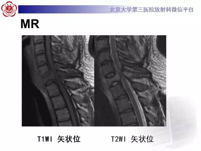 【病例】颈椎朗格汉斯组织细胞增生症1例CT及MR影像诊断