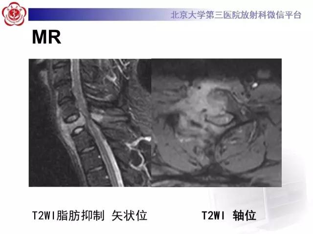 【病例】颈椎朗格汉斯组织细胞增生症1例CT及MR影像诊断