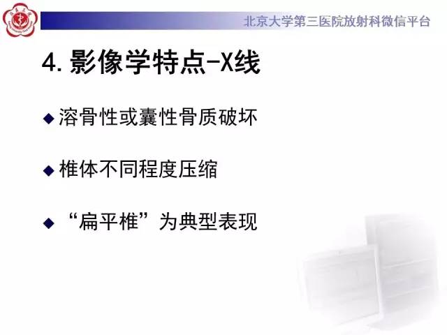 【病例】颈椎朗格汉斯组织细胞增生症1例CT及MR影像诊断