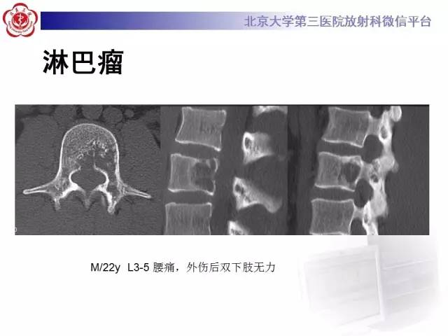 【病例】颈椎朗格汉斯组织细胞增生症1例CT及MR影像诊断