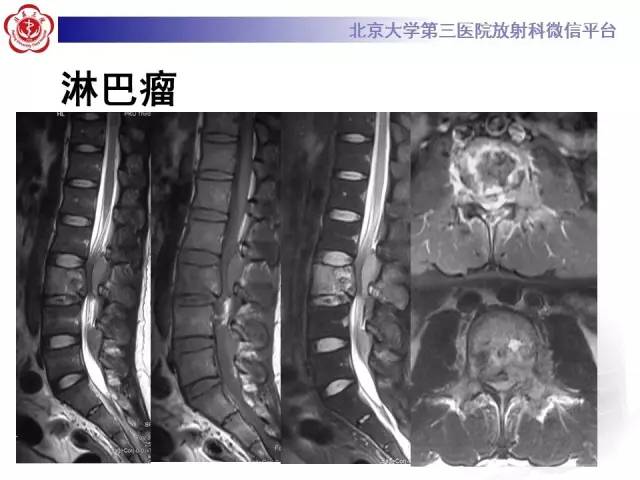 【病例】颈椎朗格汉斯组织细胞增生症1例CT及MR影像诊断