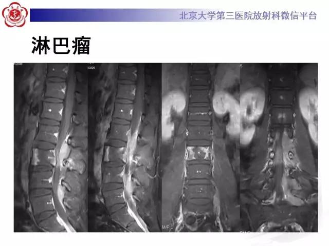 【病例】颈椎朗格汉斯组织细胞增生症1例CT及MR影像诊断