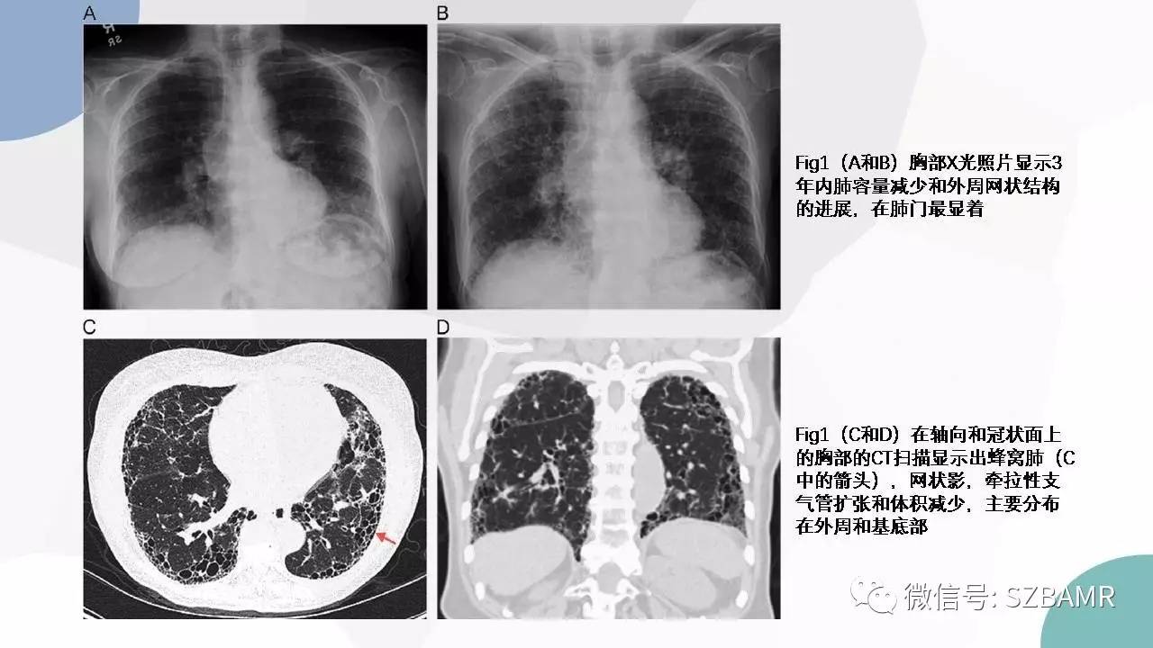 【PPT】特发性间质性肺炎的影像与病理