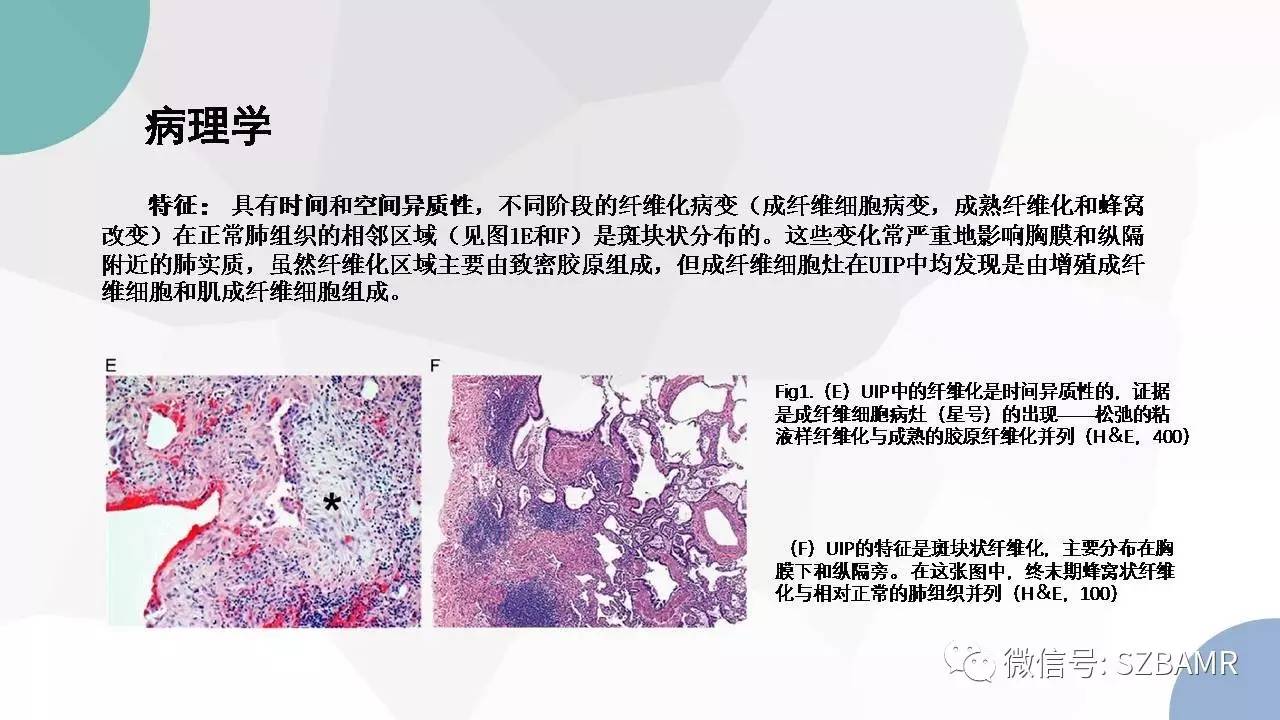 【PPT】特发性间质性肺炎的影像与病理