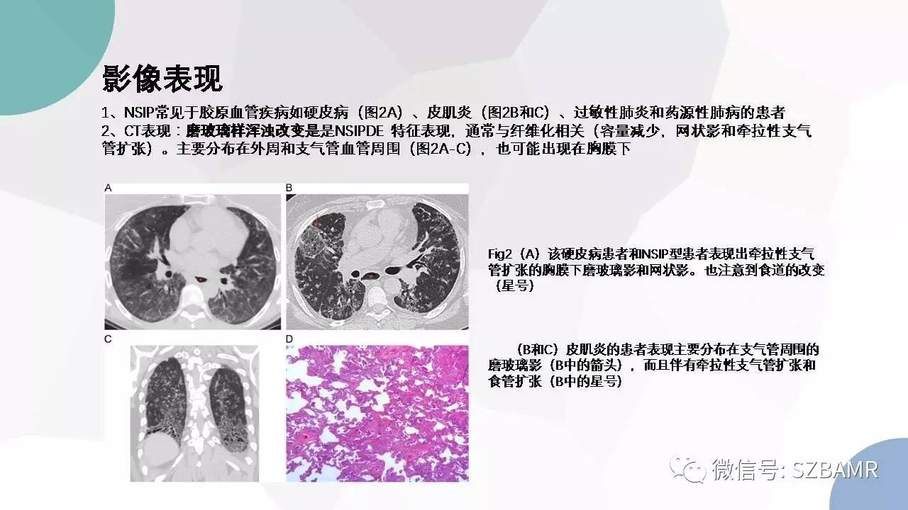 【PPT】特发性间质性肺炎的影像与病理