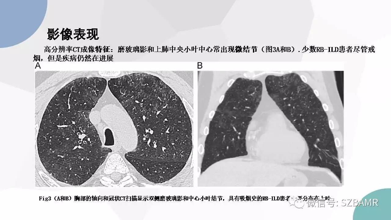 【PPT】特发性间质性肺炎的影像与病理