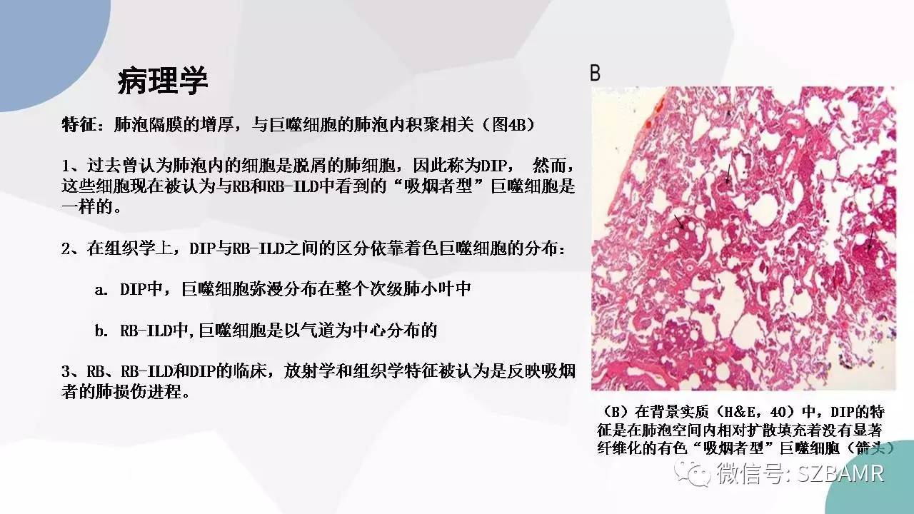 【PPT】特发性间质性肺炎的影像与病理