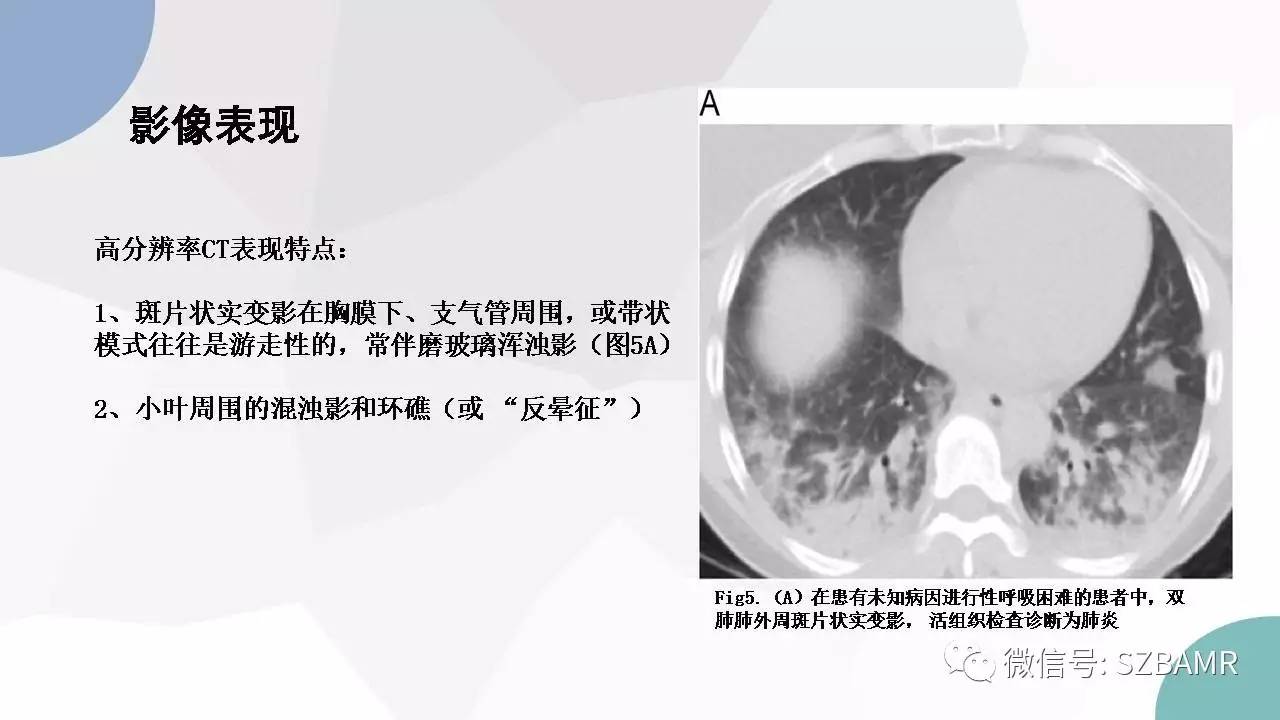 【PPT】特发性间质性肺炎的影像与病理