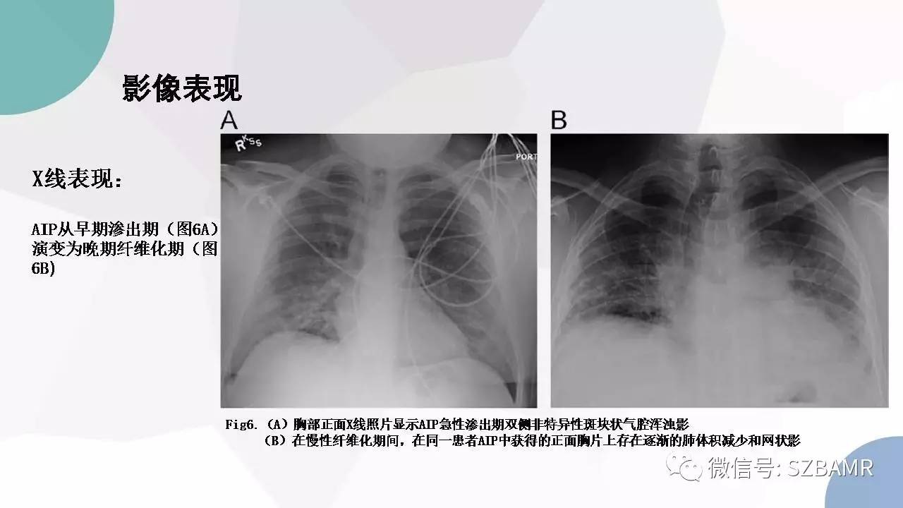 【PPT】特发性间质性肺炎的影像与病理