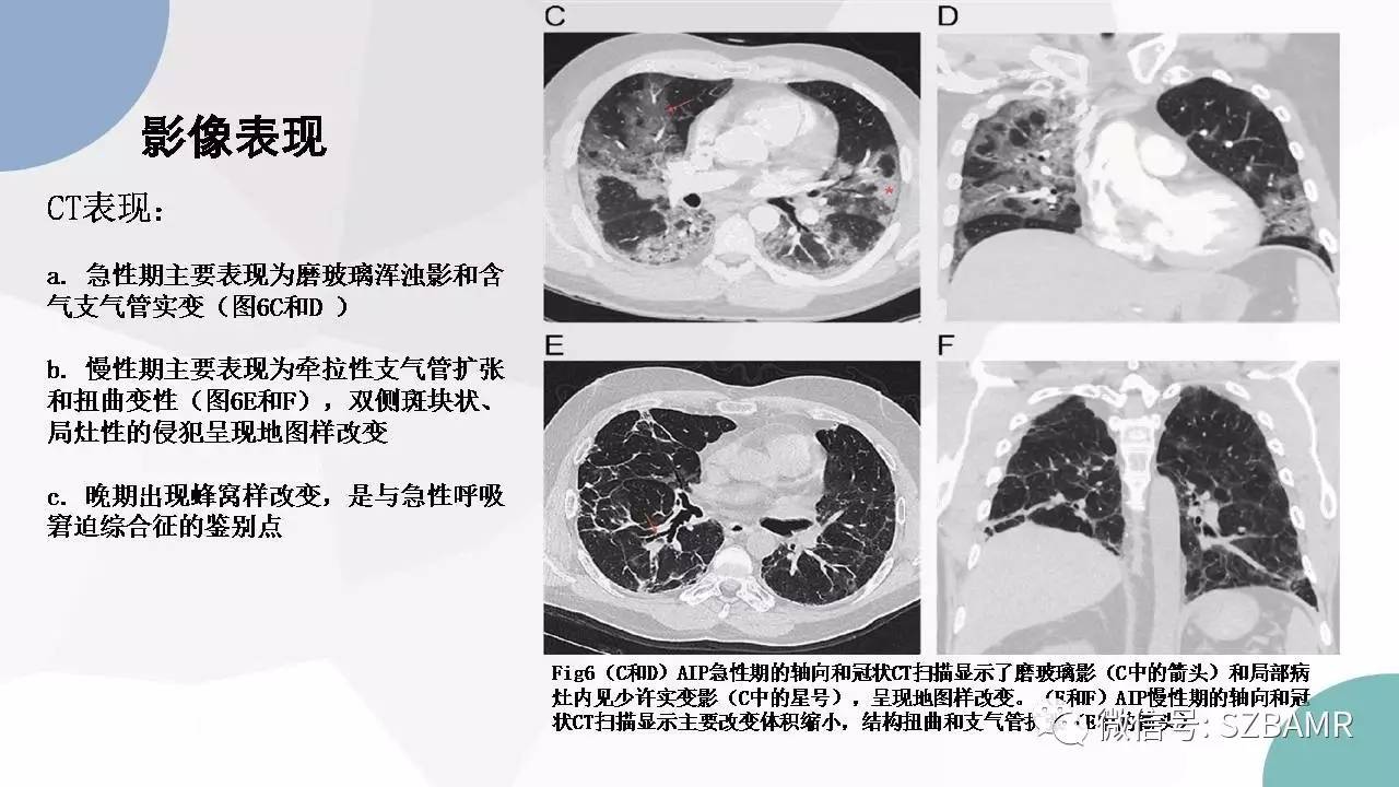 【PPT】特发性间质性肺炎的影像与病理
