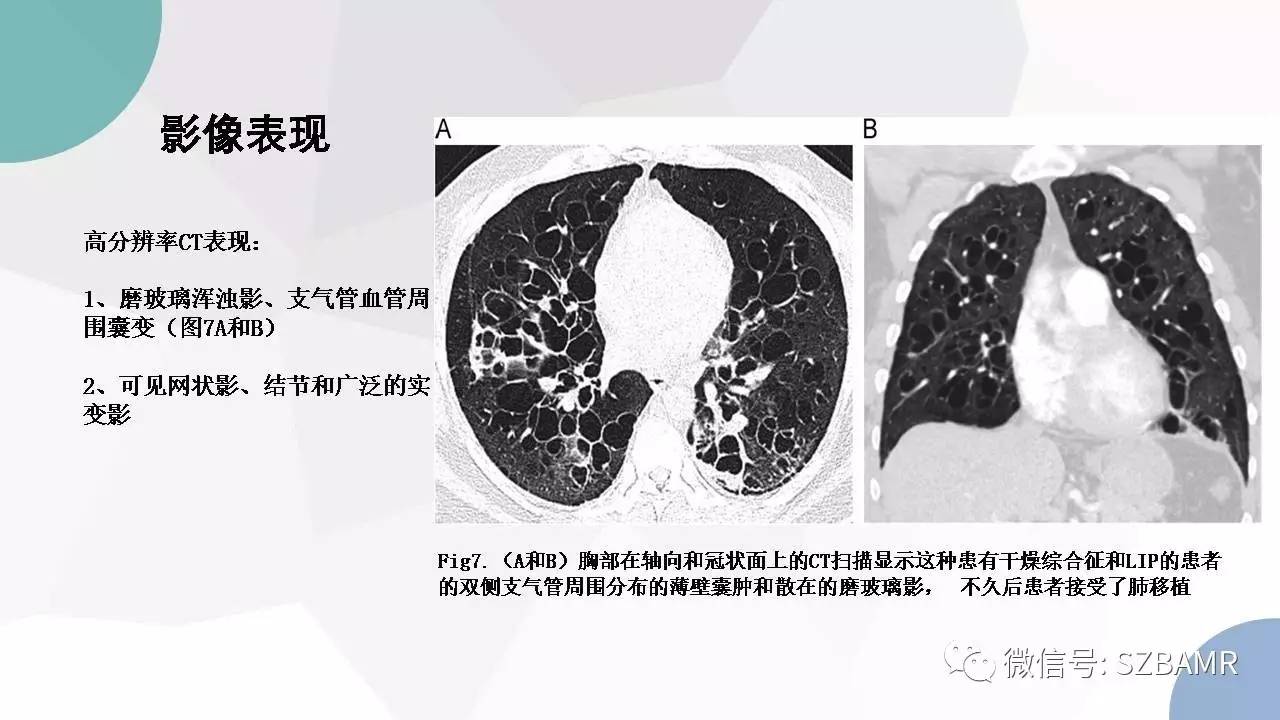 【PPT】特发性间质性肺炎的影像与病理